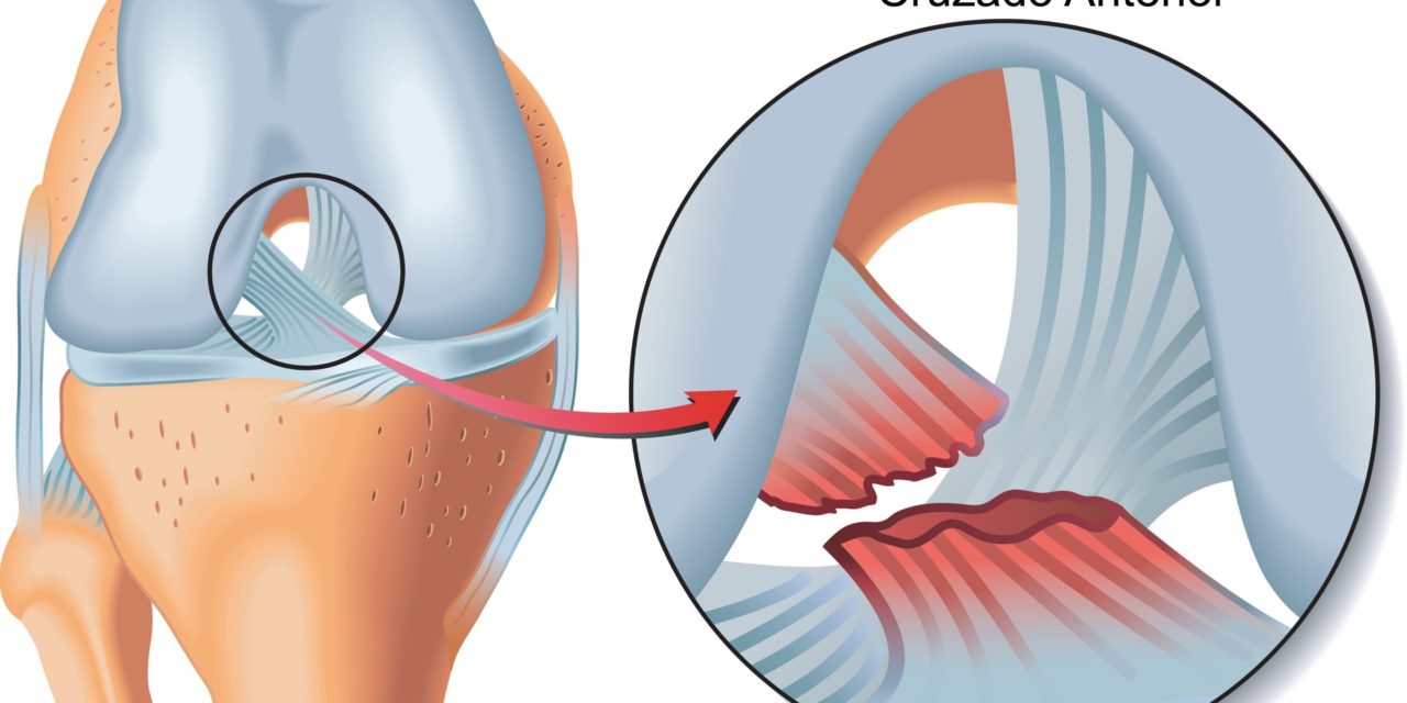 Prevención de la lesión del ligamento cruzado anterior.